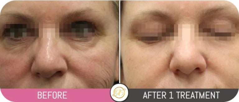 opus plasma treatment