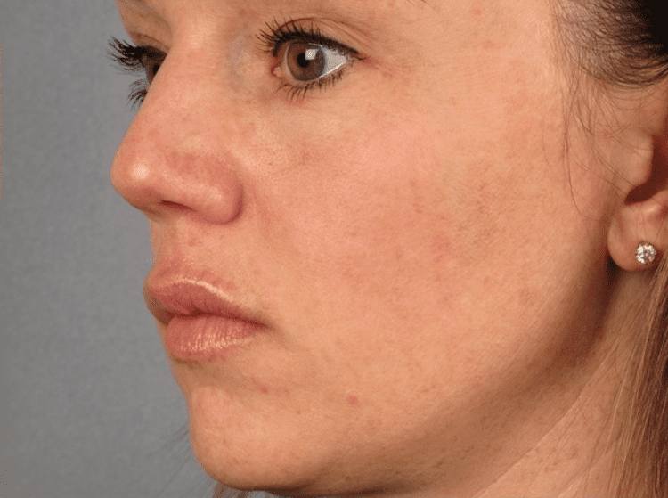 Close-up of woman’s face showing skin texture before treatment.