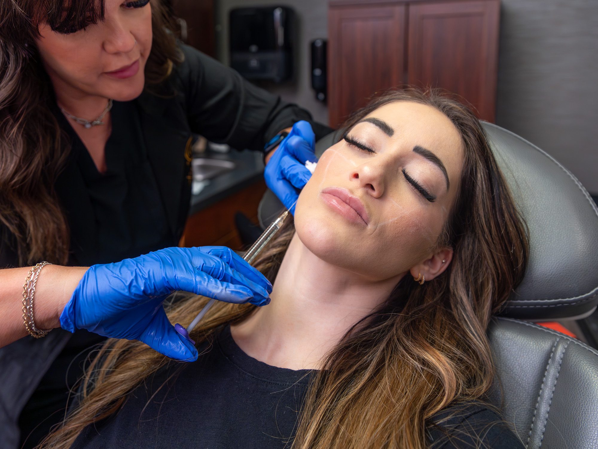 Dermal filler procedure for facial enhancement