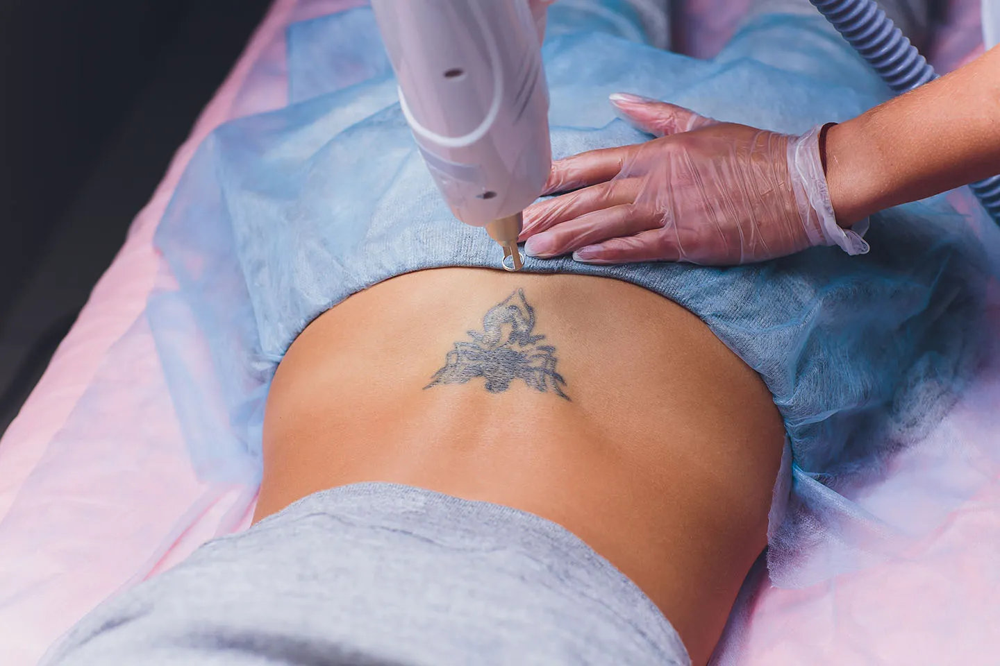 Laser Tattoo Removal - Ex name near pubis - Newhope Laser Skin Care -  Orange County, CA - Video - RealSelf