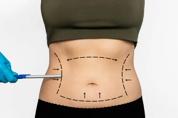 What is Laser Lipo?  Med Spa in Fort Collins
