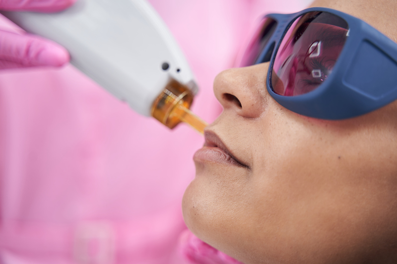 A woman is having a laser applied to her upper lip after learning how affordable laser hair removal cost near Fort Collins was.