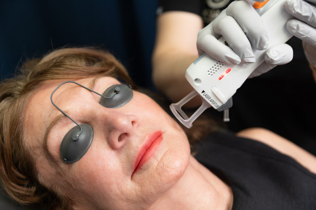 A woman is lying down with protective eye covers over her eyes as she receives acne scar treatment in Fort Collins.