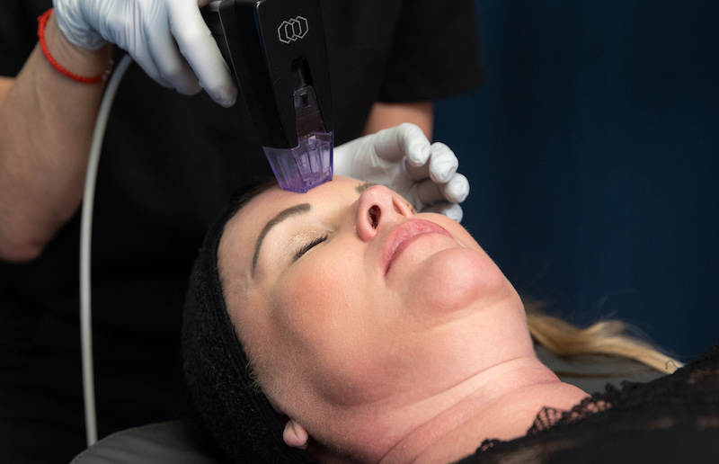 A woman is lying down as she receives acne scar treatment in Fort Collins.